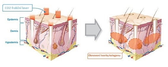 CO2 frakční resurfacing (Dermaesthetic, MUDr. Hana Šulcová, MBA)